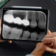 Radiografii intraorale
