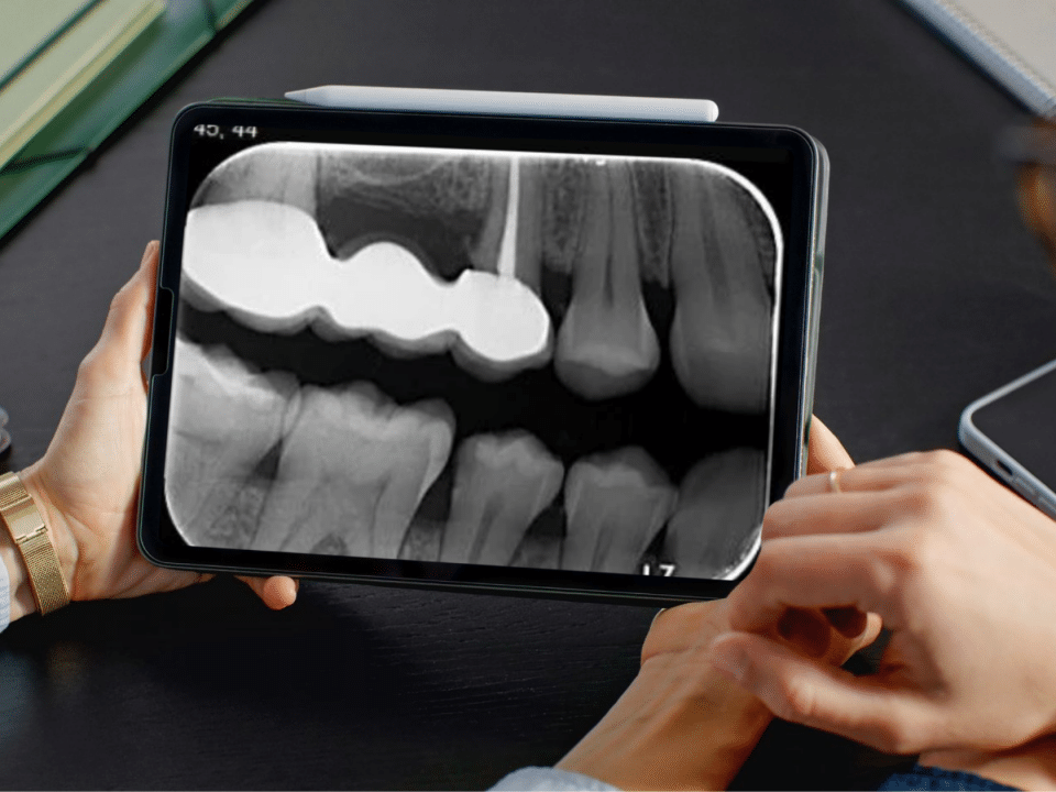 Radiografii intraorale