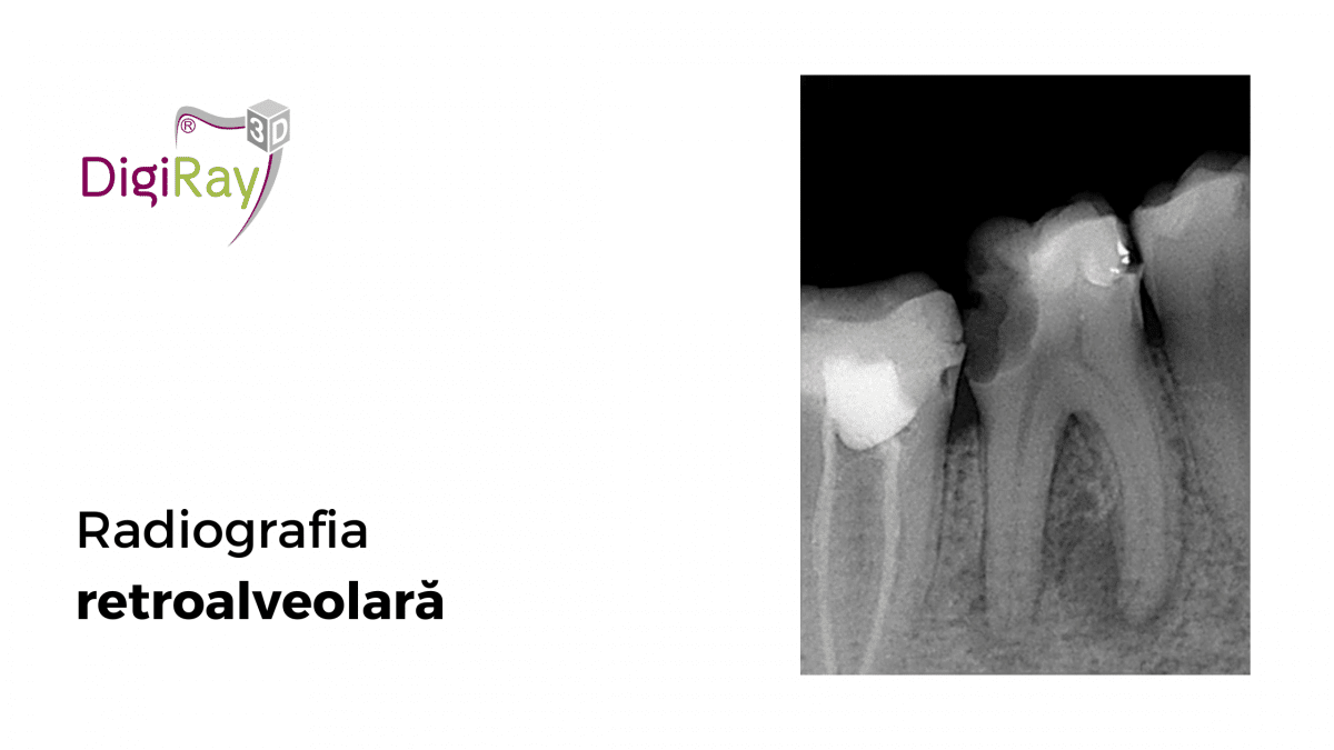 radiografia retroalveolară