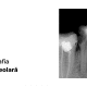radiografia retroalveolară
