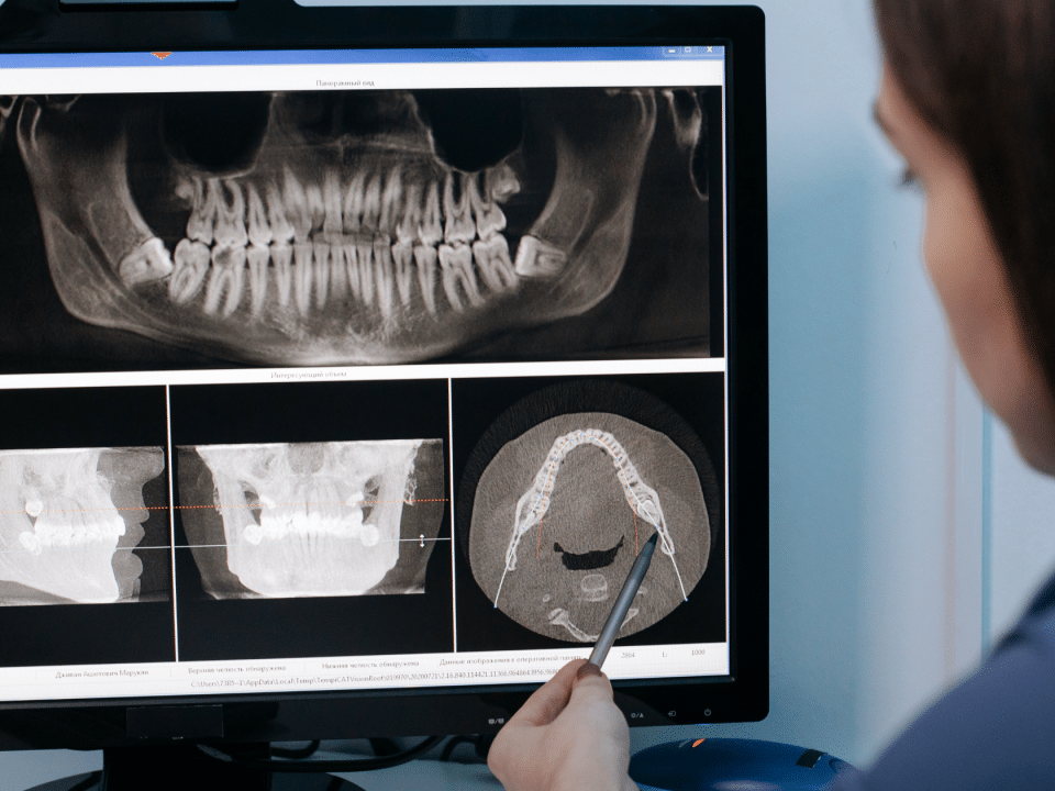 radiografie dentară